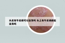 頭皮有牛皮癬可以染發(fā)嗎 頭上有牛皮病癬能染發(fā)嗎