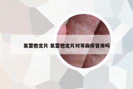氯雷他定片 氯雷他定片對蕁麻疹管用嗎