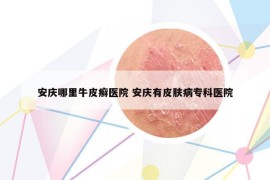 安慶哪里牛皮癬醫(yī)院 安慶有皮膚病專(zhuān)科醫(yī)院