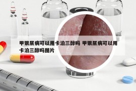 甲銀屑病可以用卡泊三醇嗎 甲銀屑病可以用卡泊三醇嗎圖片