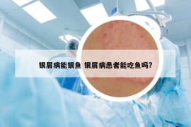 銀屑病能銀魚 銀屑病患者能吃魚嗎?