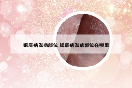 銀屑病發(fā)病部位 銀屑病發(fā)病部位在哪里