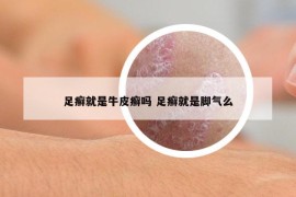 足癬就是牛皮癬嗎 足癬就是腳氣么