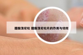 醋酸潑尼松 醋酸潑尼松片的作用與功效