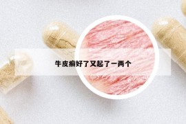 牛皮癬好了又起了一兩個(gè)