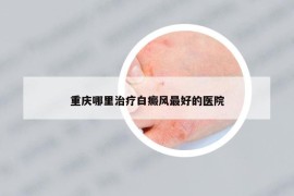 重慶哪里治療白癜風(fēng)最好的醫(yī)院