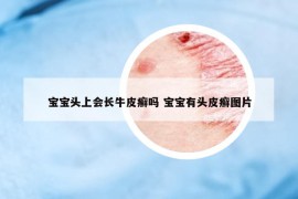 寶寶頭上會(huì)長(zhǎng)牛皮癬嗎 寶寶有頭皮癬圖片