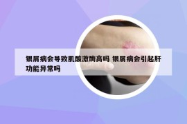 銀屑病會(huì)導(dǎo)致肌酸激酶高嗎 銀屑病會(huì)引起肝功能異常嗎