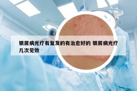 銀屑病光療有復發(fā)的有治愈好的 銀屑病光療幾次見效