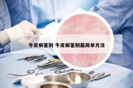 牛皮癬鑒別 牛皮癬鑒別最簡單方法