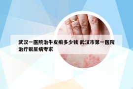 武漢一醫(yī)院治牛皮癬多少錢 武漢市第一醫(yī)院治療銀屑病專家