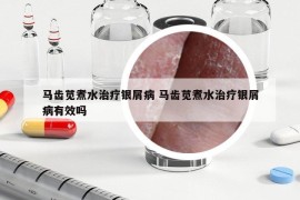 馬齒莧煮水治療銀屑病 馬齒莧煮水治療銀屑病有效嗎