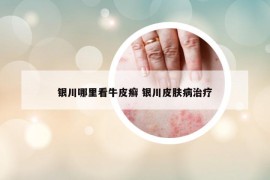 銀川哪里看牛皮癬 銀川皮膚病治療