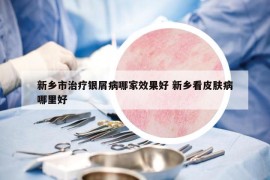 新鄉(xiāng)市治療銀屑病哪家效果好 新鄉(xiāng)看皮膚病哪里好