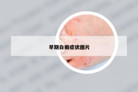 早期白癜癥狀圖片