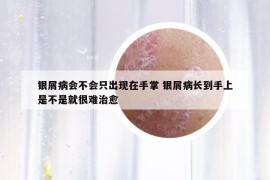 銀屑病會不會只出現(xiàn)在手掌 銀屑病長到手上是不是就很難治愈