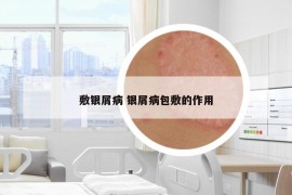 敷銀屑病 銀屑病包敷的作用