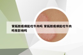 掌跖膿皰病能吃牛肉嗎 掌跖膿皰病能吃牛肉嗎有影響嗎
