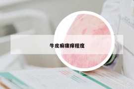 牛皮癬瘙癢程度