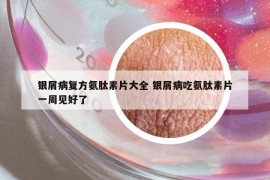 銀屑病復(fù)方氨肽素片大全 銀屑病吃氨肽素片一周見(jiàn)好了