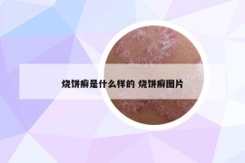 燒餅癬是什么樣的 燒餅癬圖片