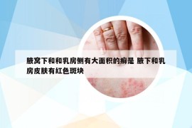 腋窩下和和乳房側有大面積的癬是 腋下和乳房皮膚有紅色斑塊