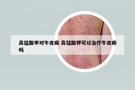 高猛酸甲對(duì)牛皮癬 高錳酸鉀可以治療牛皮癬嗎