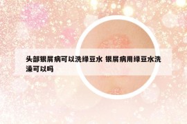 頭部銀屑病可以洗綠豆水 銀屑病用綠豆水洗澡可以嗎