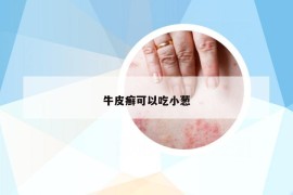 牛皮癬可以吃小蔥