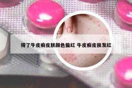 得了牛皮癬皮膚顏色偏紅 牛皮癬皮損發(fā)紅