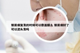 銀屑病復(fù)發(fā)的時(shí)候可以敷面膜么 銀屑病好了可以燙頭發(fā)嗎