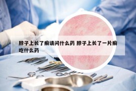 脖子上長(zhǎng)了癬請(qǐng)問(wèn)什么藥 脖子上長(zhǎng)了一片癬吃什么藥