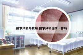 鵝掌風(fēng)和牛皮癬 鵝掌風(fēng)和濕疹一樣嗎