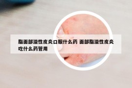 脂面部溢性皮炎口服什么藥 面部脂溢性皮炎吃什么藥管用