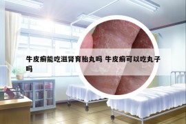 牛皮癬能吃滋腎育胎丸嗎 牛皮癬可以吃丸子嗎