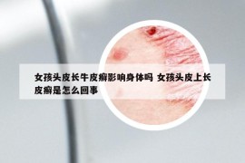 女孩頭皮長(zhǎng)牛皮癬影響身體嗎 女孩頭皮上長(zhǎng)皮癬是怎么回事
