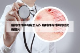 胳膊肘對(duì)稱有癬怎么辦 胳膊肘有對(duì)稱的硬皮癬圖片