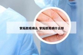 掌跖膿皰病么 掌跖膿皰病什么樣