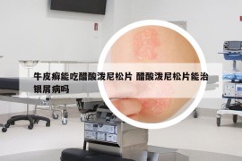 牛皮癬能吃醋酸潑尼松片 醋酸潑尼松片能治銀屑病嗎