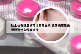 臉上也有銀屑病可以照黑光嗎 銀屑病照黑光要照到什么程度才行