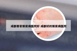 成都那家銀屑病醫(yī)院好 成都好的銀屑病醫(yī)院