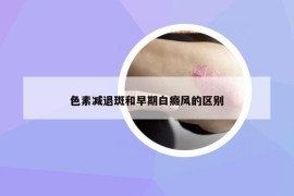 色素減退斑和早期白癜風(fēng)的區(qū)別
