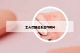 怎么識(shí)別是否是白癜風(fēng)
