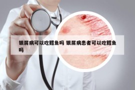 銀屑病可以吃鱈魚嗎 銀屑病患者可以吃鱈魚嗎