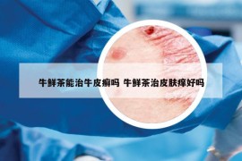 牛鮮茶能治牛皮癬嗎 牛鮮茶治皮膚癢好嗎