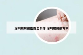 深圳銀屑病醫(yī)院怎么樣 深圳銀屑病專家