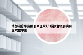 成都治療牛皮癬那家醫(yī)院好 成都治銀屑病的醫(yī)院在哪里
