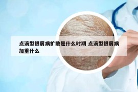 點(diǎn)滴型銀屑病擴(kuò)散是什么時(shí)期 點(diǎn)滴型銀屑病加重什么