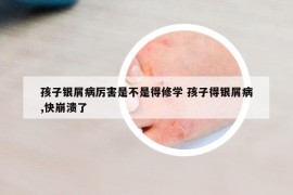 孩子銀屑病厲害是不是得修學 孩子得銀屑病,快崩潰了