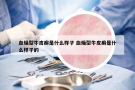 血燥型牛皮癬是什么樣子 血燥型牛皮癬是什么樣子的